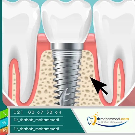 چرا پیوند استخوان فک کلید موفقیت ایمپلنت دندان است؟